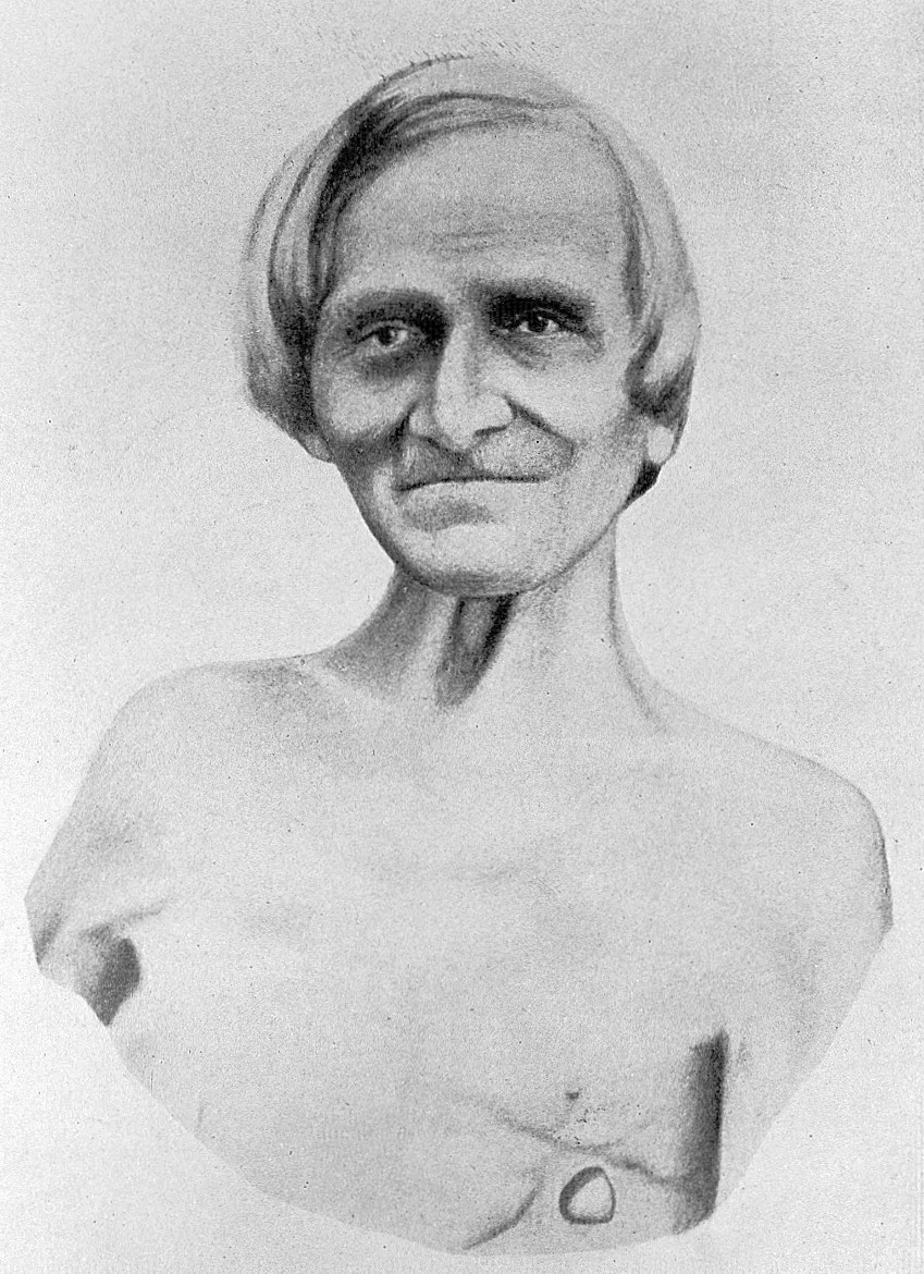 Alexis St. Martin in later life, with the healed opening into his stomach below his left breast, from Jesse Myer, Life and Letters of Dr. William Beaumont, 1912