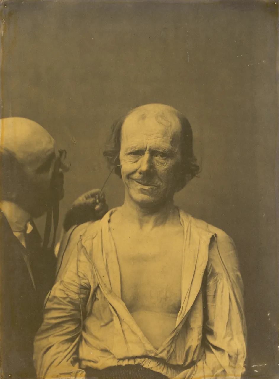 Duchenne’in deneği bir yanağında akımla, büyük elmacık kası ağzı gözlerin katılmadığı bir gülümsemeye çekiyor, 1854 ile 1856 arasında çekilmiş