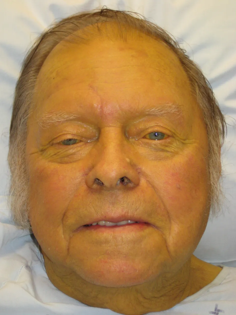 Jaundice: bilirubin colours the skin and the whites of the eyes yellow