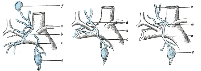Three forms of the lymph trunks at the right venous angle: they enter the veins one by one or join first in a short right lymphatic duct, Gray's Anatomy, 1918, figure 601