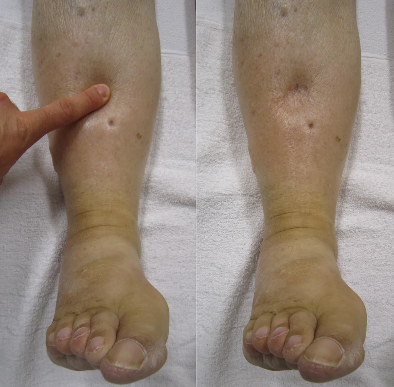 Pitting oedema: a finger pressed into a swollen lower leg leaves a dent