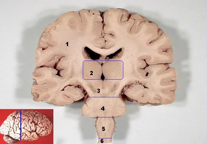 A human brain cut across from side to side: grey cortex over white matter, the two thalami (2), and below them the midbrain (3), pons (4), medulla (5) and spinal cord (6)