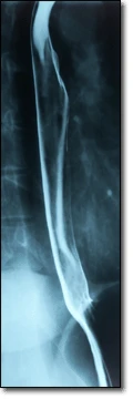 X-ray of the esophagus outlined by swallowed barium