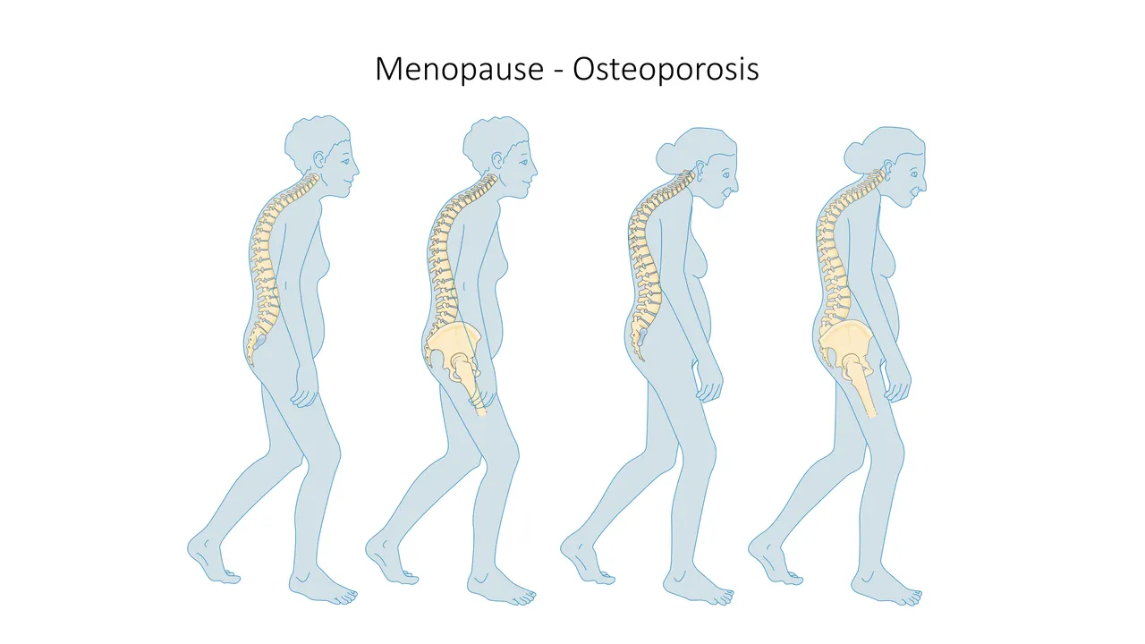 The upper back bending forward over the years as vertebrae collapse with osteoporosis