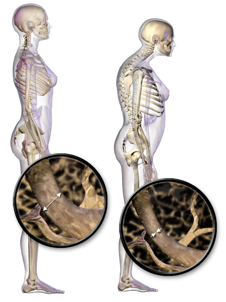 Healthy bone on the left and osteoporotic bone on the right, with thinner trabeculae and a back bent forward by collapsed vertebrae