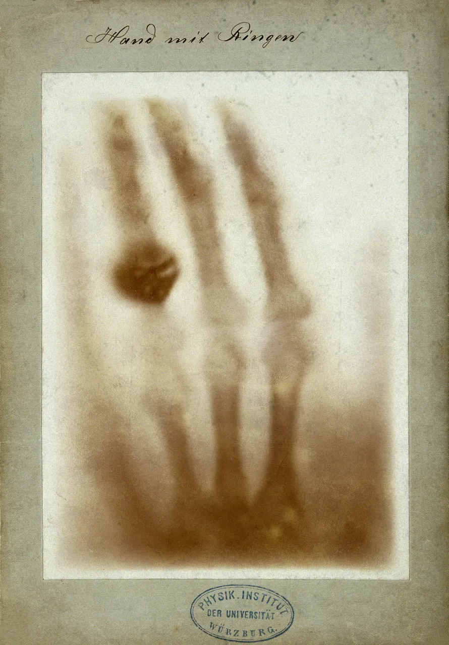 Röntgen’in karısının yüzüklü sol elinin X ışını fotoğrafı, 22 Aralık 1895