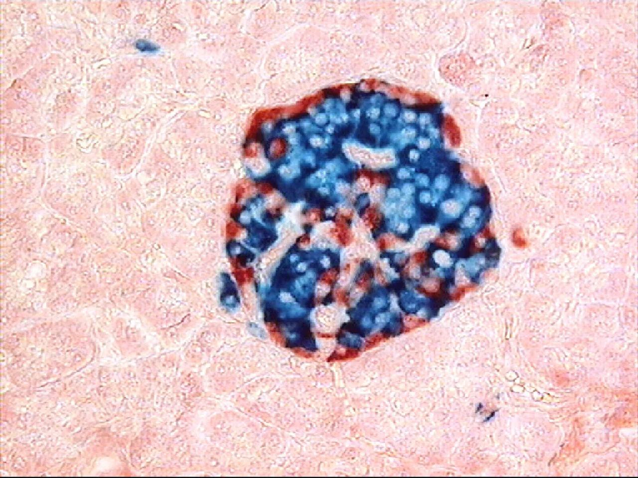 An islet of Langerhans in the human pancreas, stained for insulin (blue) and glucagon (red)