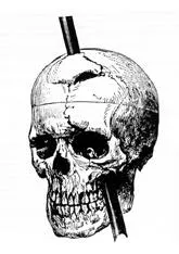 The path of the iron rod through the skull of Phineas Gage, from John Harlow's report of 1868