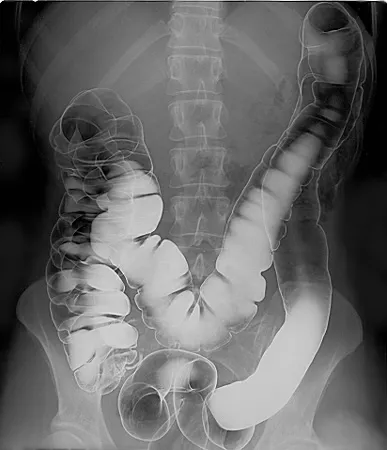 The large intestine on an X-ray, outlined by barium and air, with its pouches visible