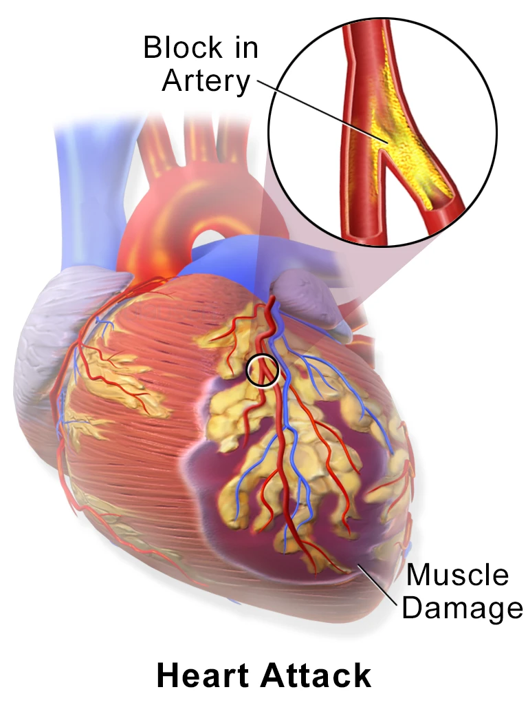 A heart attack: a clot blocks a branch of the left coronary artery and the muscle beyond it is damaged