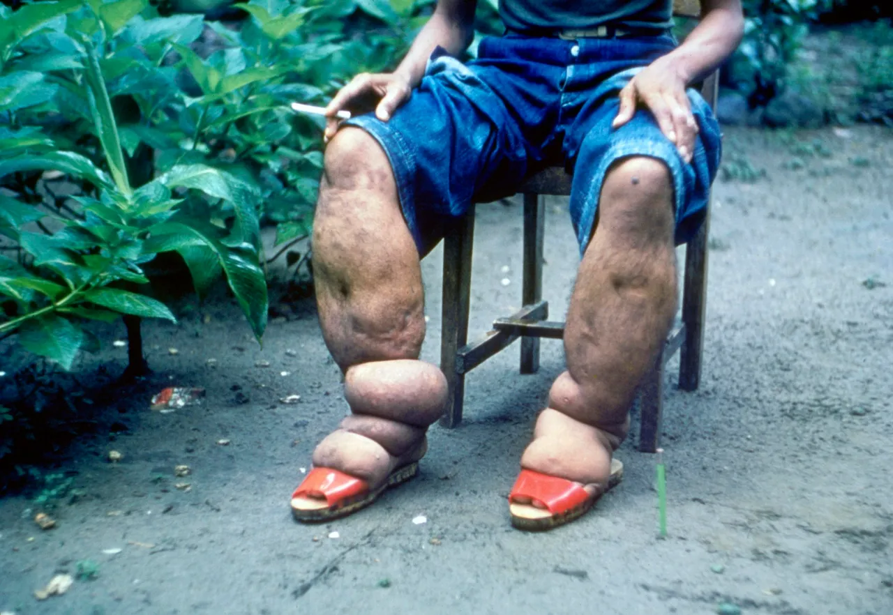 Elephantiasis of the legs from lymphatic filariasis, Luzon, Philippines, 1962, CDC Public Health Image Library